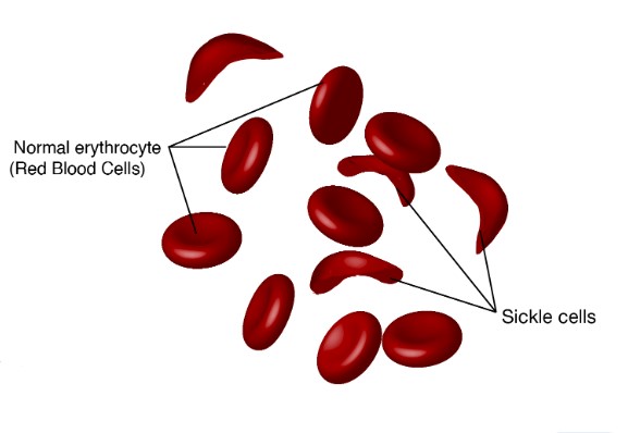 Sickle cells in blood